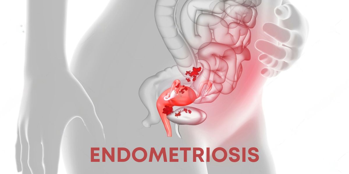 Endometriosis: It's Not Just Painful Periods