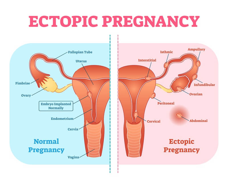 Ectopic Pregnancy
