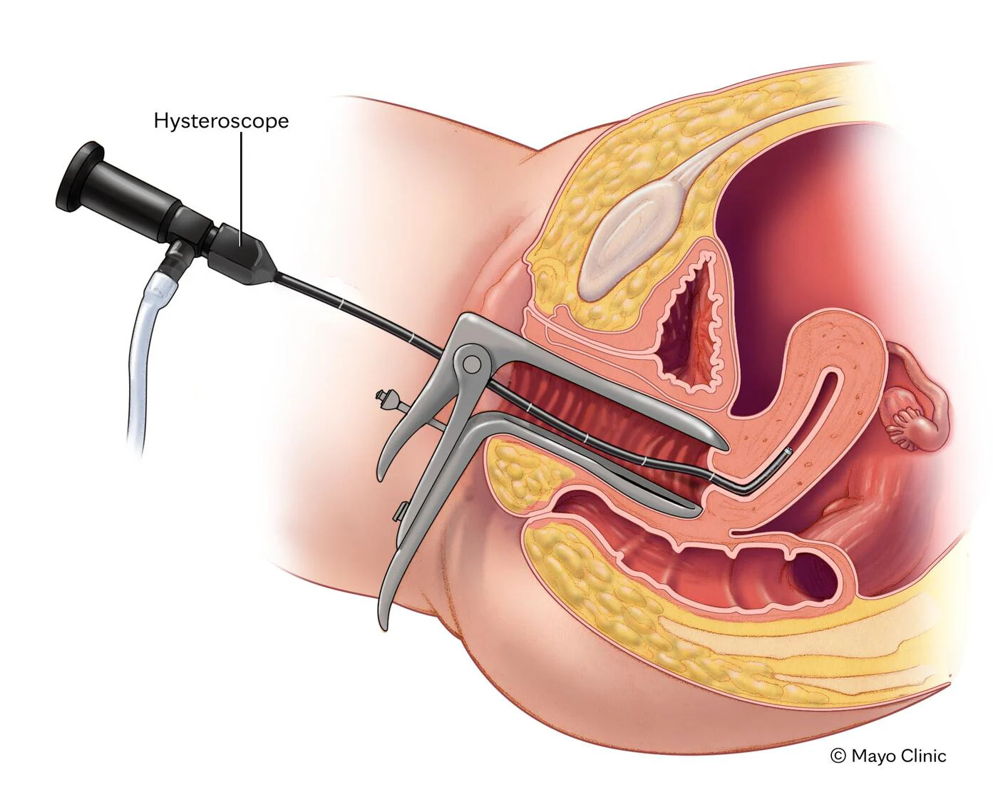 Hysteroscopic Surgeries/ Polyp Removal